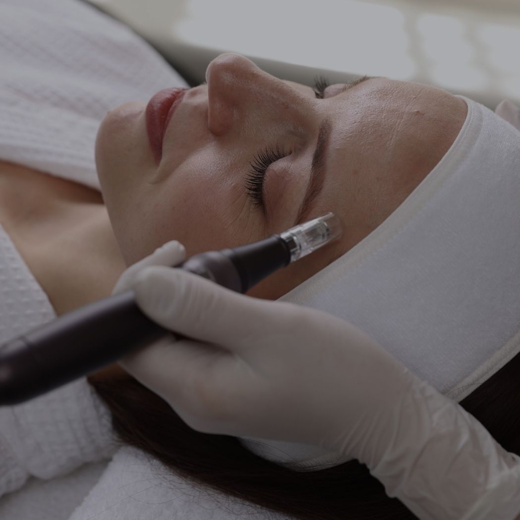 Microneedling Mönchengladbach